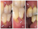 LESIONES DENTALES NO CARIOSAS: ETIOLOG&Iacute;A Y DIAGN&Oacute;STICO CL&Iacute;NICO. REVISI&Oacute;N DE LITERATURA.