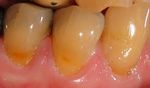 LESIONES DENTALES NO CARIOSAS: ETIOLOG&Iacute;A Y DIAGN&Oacute;STICO CL&Iacute;NICO. REVISI&Oacute;N DE LITERATURA.