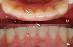 LESIONES DENTALES NO CARIOSAS: ETIOLOG&Iacute;A Y DIAGN&Oacute;STICO CL&Iacute;NICO. REVISI&Oacute;N DE LITERATURA.