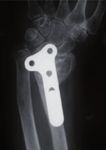 Osteotomía palmar para el tratamiento de la mala unión del radio distal: descripción de una técnica