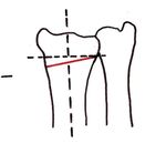 Osteotomía palmar para el tratamiento de la mala unión del radio distal: descripción de una técnica
