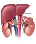 Colocaci&oacute;n y remoci&oacute;n de filtro en la vena cava inferior - RadiologyInfo.org