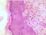 Modelo experimental de queratosis act&iacute;nica por exposici&oacute;n a radiaci&oacute;n ultravioleta A