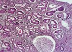 Hiperplasia endometrial: clasificaci&oacute;n y manejo actual
