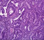 Hiperplasia endometrial: clasificaci&oacute;n y manejo actual