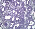 Hiperplasia endometrial: clasificaci&oacute;n y manejo actual