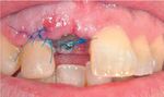Tratamiento Laser-Lok en implantes dentales. A propósito de un caso clínico