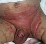 GU&Iacute;AS DIAGN&Oacute;STICAS Y TERAP&Eacute;UTICAS DE LAS 10 PATOLOG&Iacute;AS M&Aacute;S FRECUENTES - HOSPITAL INFANTIL DE M&Eacute;XICO "FEDERICO G&Oacute;MEZ" SERVICIO DE DERMATOLOG&Iacute;A - himfg
