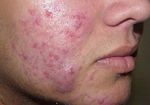 GU&Iacute;AS DIAGN&Oacute;STICAS Y TERAP&Eacute;UTICAS DE LAS 10 PATOLOG&Iacute;AS M&Aacute;S FRECUENTES - HOSPITAL INFANTIL DE M&Eacute;XICO "FEDERICO G&Oacute;MEZ" SERVICIO DE DERMATOLOG&Iacute;A - himfg