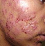 GU&Iacute;AS DIAGN&Oacute;STICAS Y TERAP&Eacute;UTICAS DE LAS 10 PATOLOG&Iacute;AS M&Aacute;S FRECUENTES - HOSPITAL INFANTIL DE M&Eacute;XICO "FEDERICO G&Oacute;MEZ" SERVICIO DE DERMATOLOG&Iacute;A - himfg