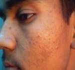 GU&Iacute;AS DIAGN&Oacute;STICAS Y TERAP&Eacute;UTICAS DE LAS 10 PATOLOG&Iacute;AS M&Aacute;S FRECUENTES - HOSPITAL INFANTIL DE M&Eacute;XICO "FEDERICO G&Oacute;MEZ" SERVICIO DE DERMATOLOG&Iacute;A - himfg