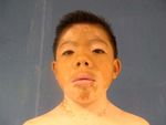 GU&Iacute;AS DIAGN&Oacute;STICAS Y TERAP&Eacute;UTICAS DE LAS 10 PATOLOG&Iacute;AS M&Aacute;S FRECUENTES - HOSPITAL INFANTIL DE M&Eacute;XICO "FEDERICO G&Oacute;MEZ" SERVICIO DE DERMATOLOG&Iacute;A - himfg