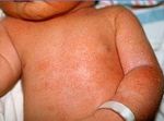 GU&Iacute;AS DIAGN&Oacute;STICAS Y TERAP&Eacute;UTICAS DE LAS 10 PATOLOG&Iacute;AS M&Aacute;S FRECUENTES - HOSPITAL INFANTIL DE M&Eacute;XICO "FEDERICO G&Oacute;MEZ" SERVICIO DE DERMATOLOG&Iacute;A - himfg