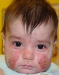 GU&Iacute;AS DIAGN&Oacute;STICAS Y TERAP&Eacute;UTICAS DE LAS 10 PATOLOG&Iacute;AS M&Aacute;S FRECUENTES - HOSPITAL INFANTIL DE M&Eacute;XICO "FEDERICO G&Oacute;MEZ" SERVICIO DE DERMATOLOG&Iacute;A - himfg