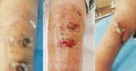 Herida por mordedura de perro en pierna tratada con apósitos de acción física impregnados con DACC (cloruro de diaquilcarbamilo) - HERIDAS Y ...