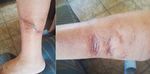 Herida por mordedura de perro en pierna tratada con apósitos de acción física impregnados con DACC (cloruro de diaquilcarbamilo) - HERIDAS Y ...
