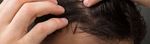 LA ALOPECIA Y SUS POSIBLES TRATAMIENTOS - www.imdermatologico.com