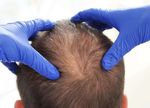 LA ALOPECIA Y SUS POSIBLES TRATAMIENTOS - www.imdermatologico.com