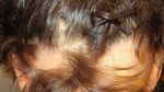 LA ALOPECIA Y SUS POSIBLES TRATAMIENTOS - www.imdermatologico.com