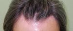 LA ALOPECIA Y SUS POSIBLES TRATAMIENTOS - www.imdermatologico.com