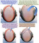 Datos generales sobre la P&eacute;rdida de cabello y el Trasplante de cabello
