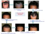 Datos generales sobre la P&eacute;rdida de cabello y el Trasplante de cabello