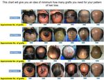 Datos generales sobre la P&eacute;rdida de cabello y el Trasplante de cabello