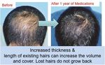 Datos generales sobre la P&eacute;rdida de cabello y el Trasplante de cabello
