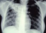 Tuberculosis en M&eacute;xico - Est&aacute;ndares para la Atenci&oacute;n de la