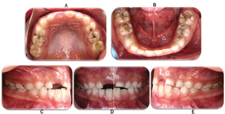 Caries En Dentición Decidua Y Riesgo De Pérdida Del Primer Molar ...