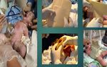 DEFECTOS DE ABDOMINAL EN RECIEN NACIDOS - PARED Dra. Sandra Toledo Becada de Pediatria