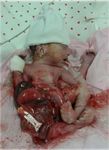 DEFECTOS DE ABDOMINAL EN RECIEN NACIDOS - PARED Dra. Sandra Toledo Becada de Pediatria