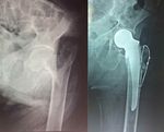 Artroplastía Parcial de Cadera con Banda de Tensión en Fracturas de Fémur Proximal en Pacientes Ancianos